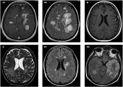 Case Report: Exacerbation of Relapses Following mRNA COVID-19 Vaccination in Multiple Sclerosis: A Case Series